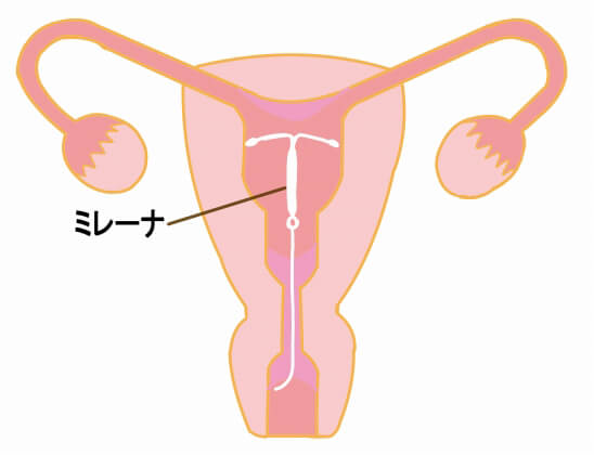 ミレーナとは？何のために装着するの？