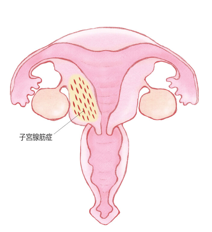 子宮腺筋症とは