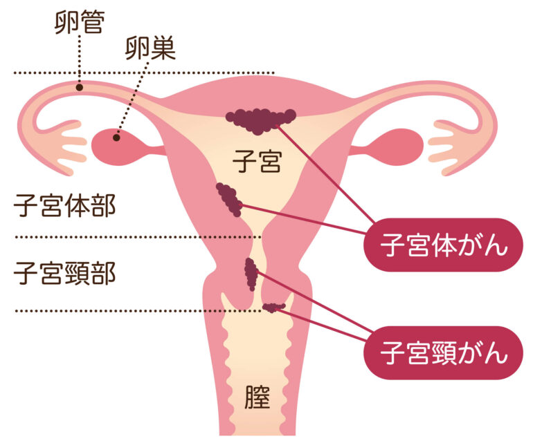 子宮頸がん・子宮体がん（子宮内膜がん）